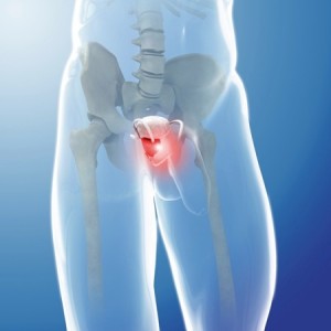 Prostate cancer