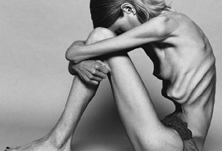 Anorexia