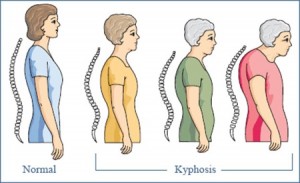 Osteoporosis