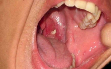 Si usted ha estado en contacto cercano con una persona que tenga difteria, consulte con un médico. Pregunte si necesita antibióticos para evitar contraer la enfermedad