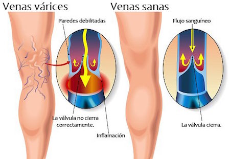 varices011